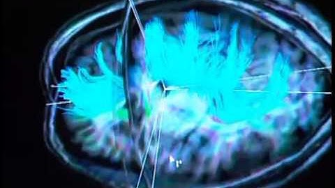 Diffusion Tensor Imaging