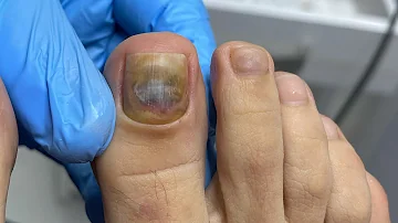 ¿A qué edad se engrosan las uñas de los pies?