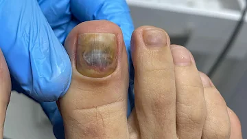 ¿Qué pasa si no te limpias las uñas de los pies?
