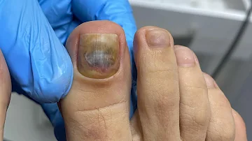 ¿Qué ocurre si no te lavas las uñas de los pies?