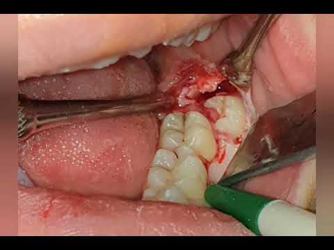 🦷 Kemik içinde tam gömük 20 yaş diş operasyonu 🦷