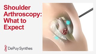 Shoulder Arthroscopy Surgery Preparation, Procedure & Recovery Explained Depuy Synthes