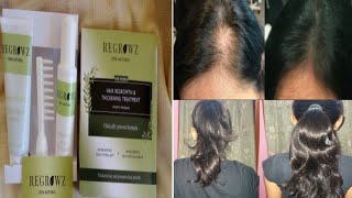 HairGrowth|My Hair Regrowth Journey|REGROWZ|Best Solution for Thin,Baldness,Hairloss