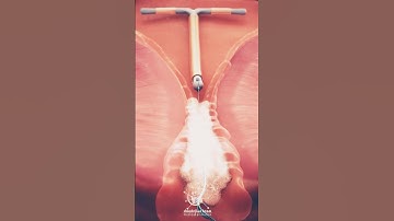 Copper IUD is wrapped in a small piece of copper #biology #femaleanatomy