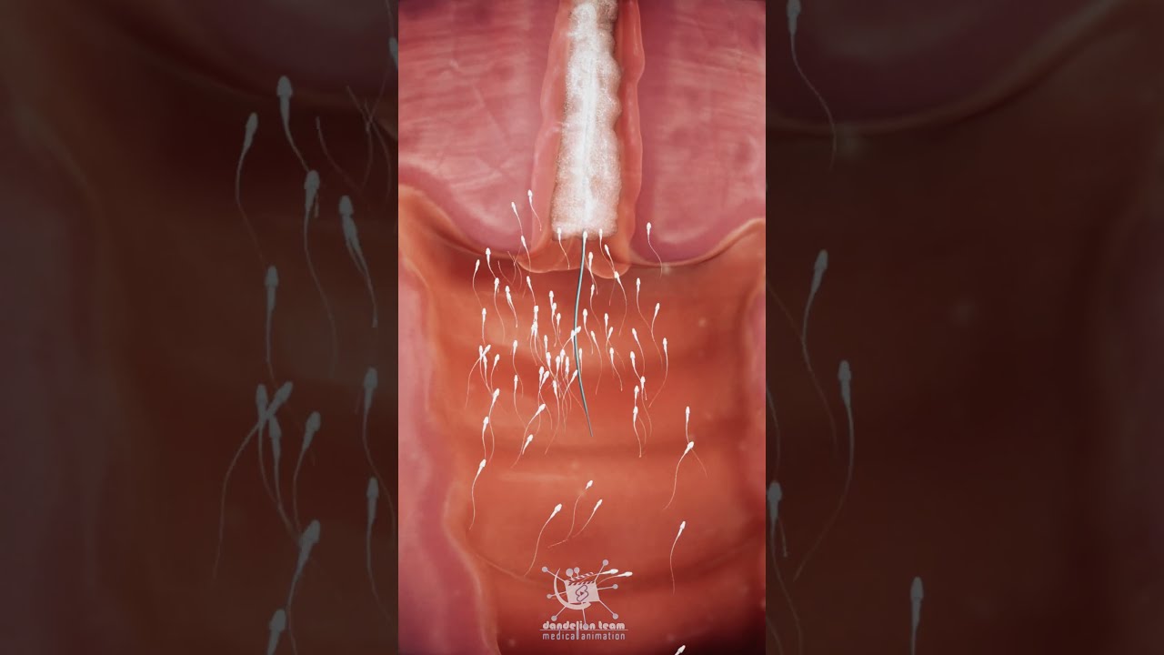 Copper IUD Is Wrapped In A Small Piece Of Biology Femaleanatomy