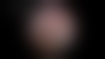 The 5MM Appendectomy Featuring the JustRight 5mm Stapler