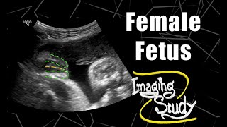 Female Fetus - Its a Girl || Ultrasound || Case 67