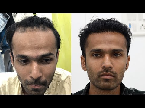 natural-hair-line-transplant-2019-|-new-roots-hair-transplant-|-hair-restoration-by-fue-technique