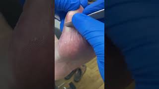 Experience Some Toe-Curling Scalpel Action! Witness A Podiatrist In Australia Taking Down Big Toe Ca