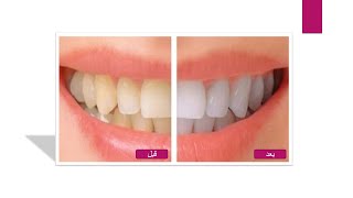 وصفات طبيعية لتبييض الاسنان وعلاج مشاكل اللثة | الصحة