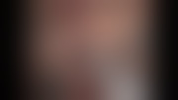 Robotic S8 R1Vascular liver resection after open multiple wedge resection for colorectal metastasis