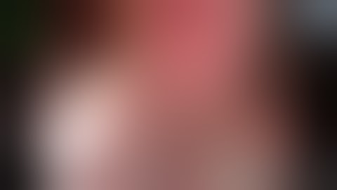 Laparoscopic Left Lateral Sectionectomy in Previous Ruptured HCC (Educational Uncut)