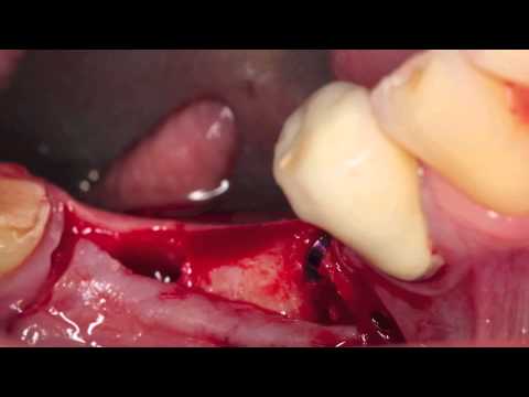 MD Guide Implant Spacing &amp; Jack Hahn Implant Placement Glidewell