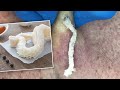 Gritty tripelike cyst squeezed out  contour dermatology