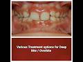 Braces process - deep bite !Braces and Overbite in Indians