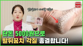 피부과전문의가 알려드리는, 단돈 5000원으로 발 뒤꿈치 각질 종결하는법! - 이건 제발 하지 마세요!
