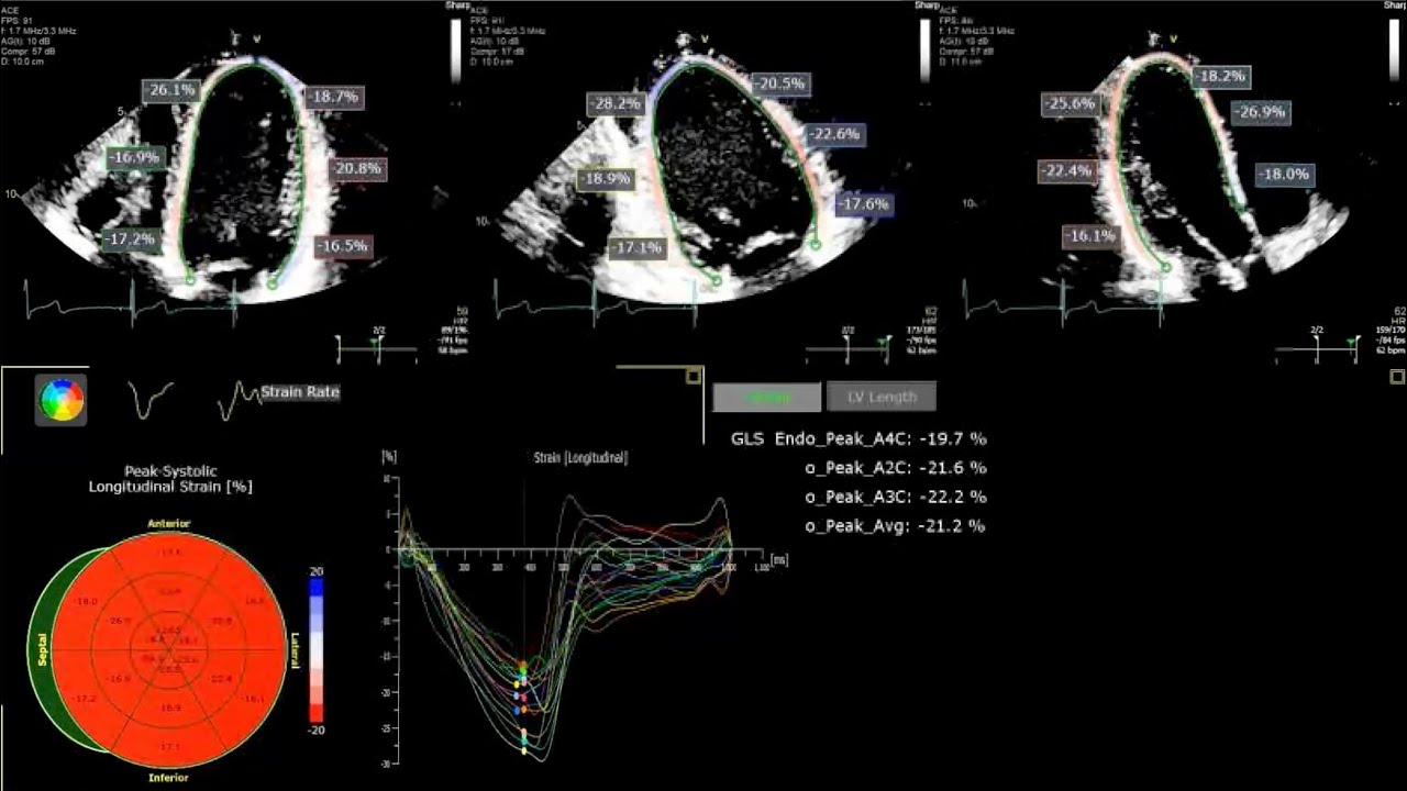 Global Longitudinal Strain (GLS - PART 1) 