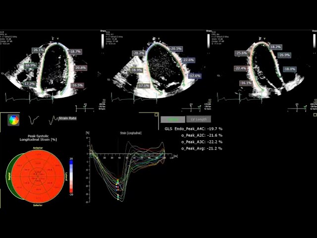 A Practical Guide to Echocardiographic Global Longitudinal Strain (GLS) by  2D Speckle Tracking 