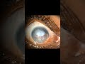 #Bullous#Keratopathy#Blister#Like#Swelling#Pseudophakic#Endothelial#Dysfunction#SEH#Karur#
