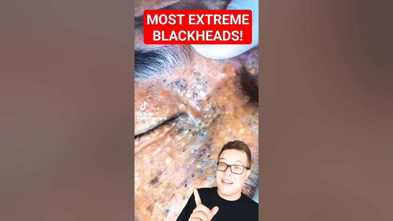 Shocking BLACKHEAD REMOVAL Extreme Blackhead Extraction shorts YouTube
