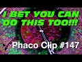 Phaco clip 147  i bet you can do this too