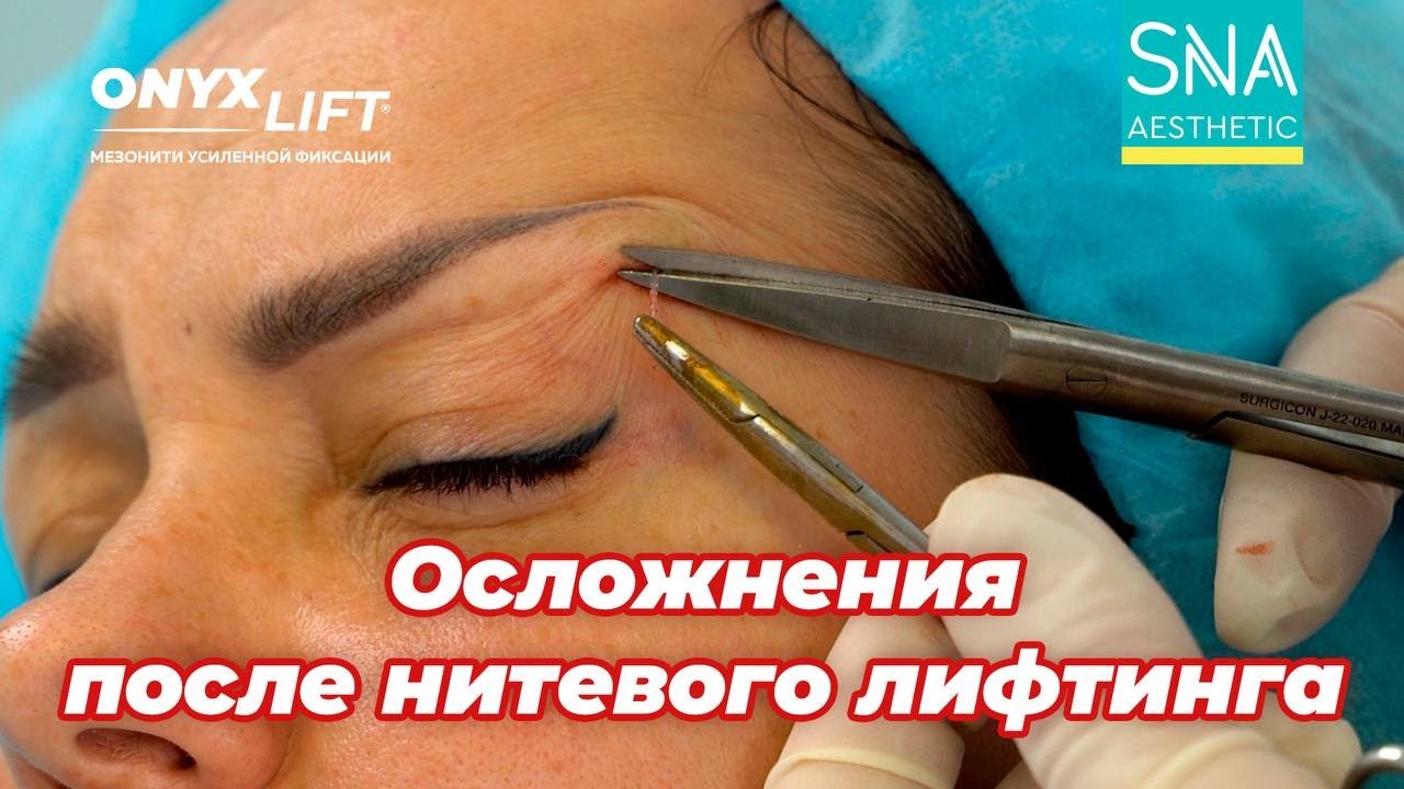 Осложнения после нитевого лифтинга бывают, но нечасто.