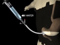 G-Tube Overview Animation