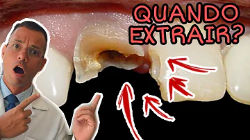 Qual o nome do procedimento para tirar cárie?