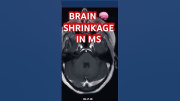 Brain 🧠 Shrinkage & Black Holes in Multiple Sclerosis
