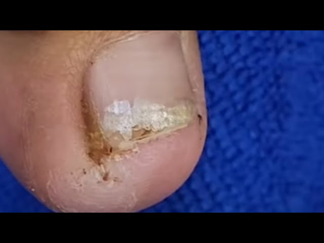 Sarisfying and profession toenail treatment