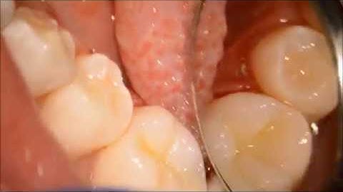 Direct composite overlay