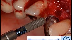 Straumann-Dental Implant Surgery-Step by Step- Part 1. 