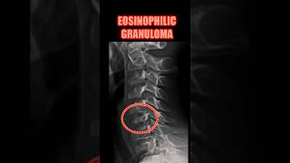 Eosinophilic Granuloma