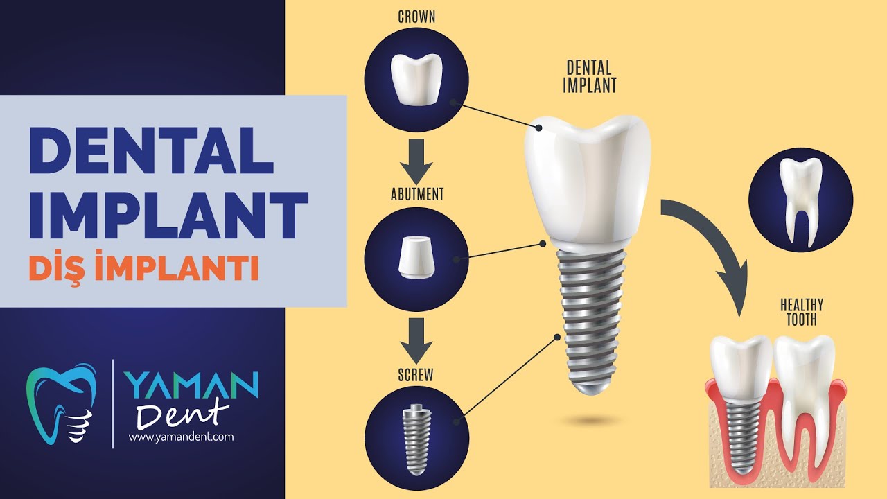 Dental Implant Turkey / Türkiye'de Diş İmplant'ı. YouTube