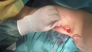 Kol Germe Ameliyatı (Arm Lift) Op. Dr. Tamer Şakrak
