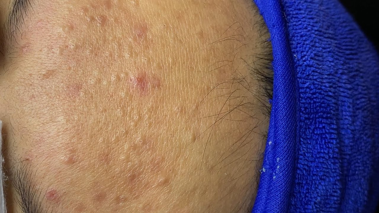Forehead acne and pimples | Làm Sạch Mụn Trán - SacDepSpa#254