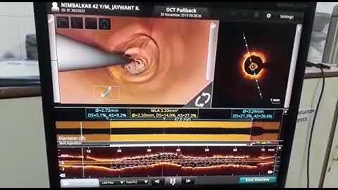 OCT of heart vessels