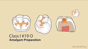 Class I Amalgam Preparation | My Dental Key