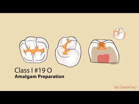 Class I Amalgam