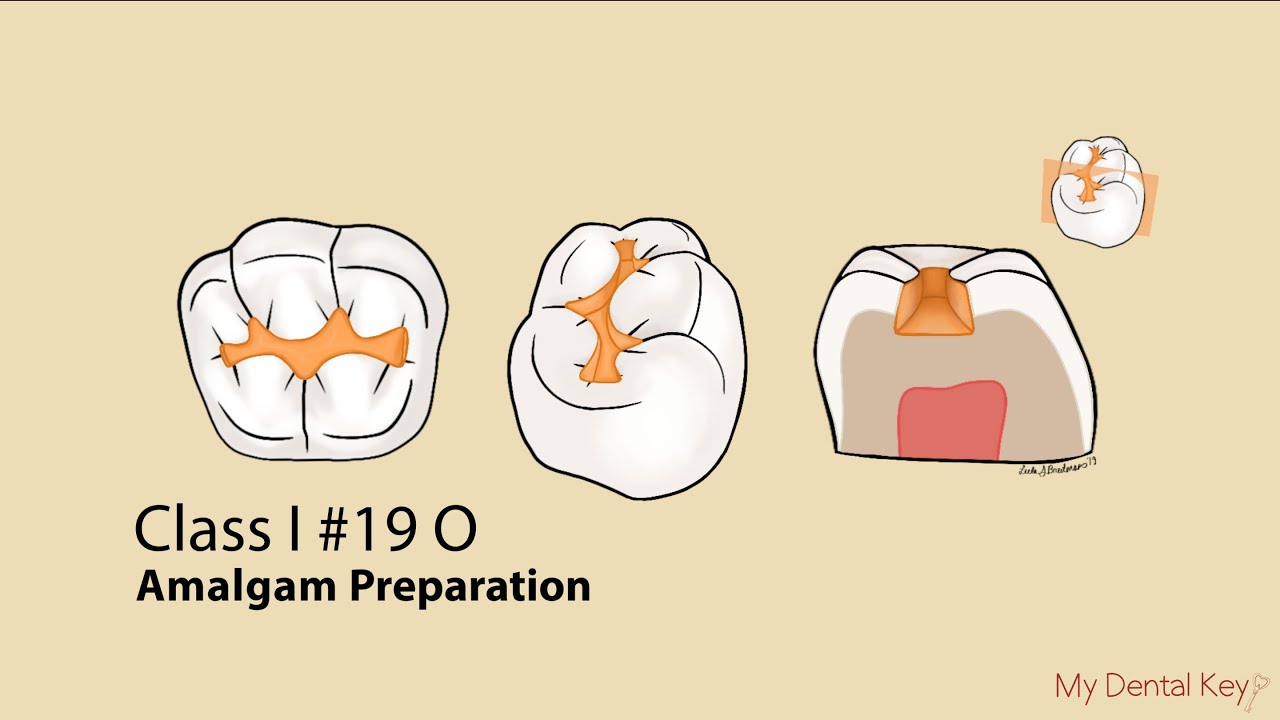 Class I Amalgam Preparation My Dental Key YouTube