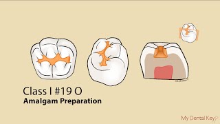 Class I Amalgam Preparation | My Dental Key