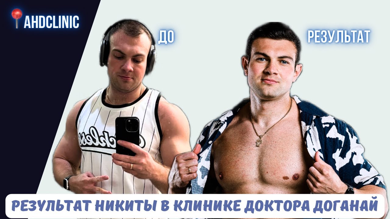 НИКИТА ИГОШЕВ И ЕГО РЕЗУЛЬТАТ ПЕРЕСАДКИ ВОЛОС В КЛИНИКЕ ДОКТОРА ХАКАН ДОГАНАЙ