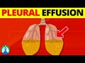 Pleural Effusion (Medical Definition) | Quick Explainer Video