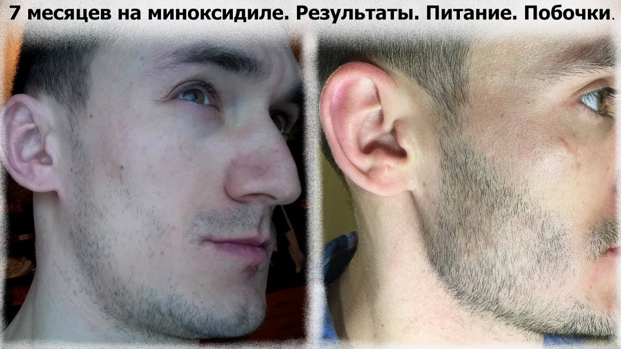 Миноксидил побочные. Миноксидил для бороды Результаты. Миноксидил для бороды эффект. Minoxidil для бороды результат. Эффект от миноксидила до и после.