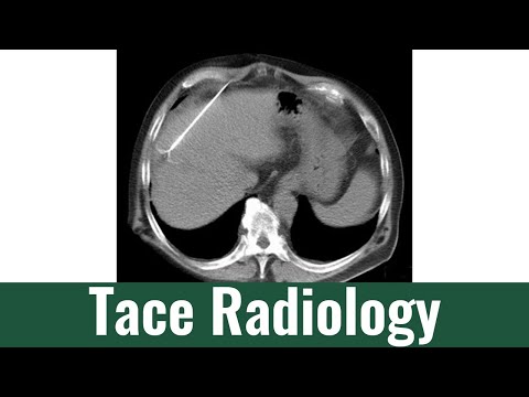 Transarterial Chemoembolization (TACE) Therapy & Procedure: Hepatic Arterial Infusion Chemotherapy