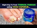 Toenail fungus treatment the right way to treat toe nail fungus with vicks vaporub