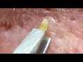 【No.8】角栓抜き&押し出し!Pull out the nose blackheads.