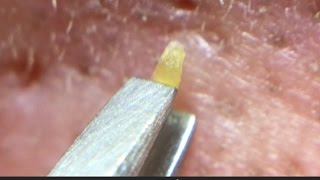 【No.8】角栓抜き&押し出し!Pull out the nose blackheads.