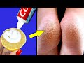 Remove Cracked Heels and Get Beautiful Feet|Magical Cracked Heels Home Remedy
