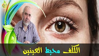 وصفة فعالة لإزالة الكلف الموجود بمحيط العين   -   الدكتور كريم العابد العلوي   -